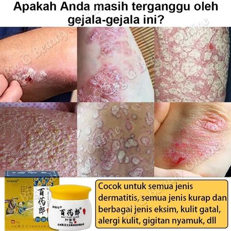 Krim Eksim Bayi dan Anak Obat gatal selangkangan salep miss v gatal Mengobati psoriasis dan eksimSal