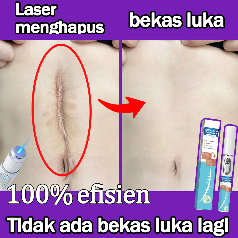 Pena-penghilang-bekas-luka-laser-menghilangkan-bekas-luka-memperbaiki-kulit-cocok-untuk-luka-bakar-b