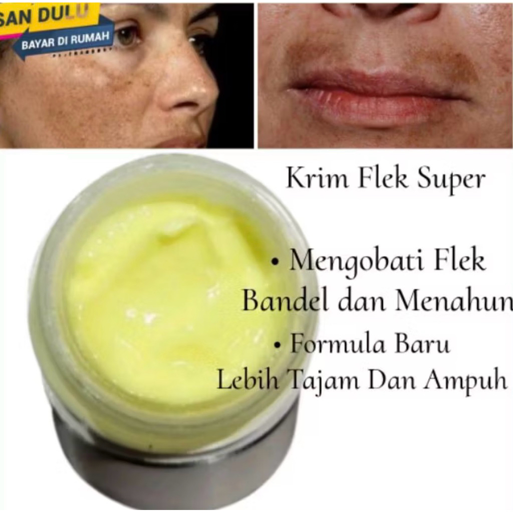 cream malam flek hitam melasma