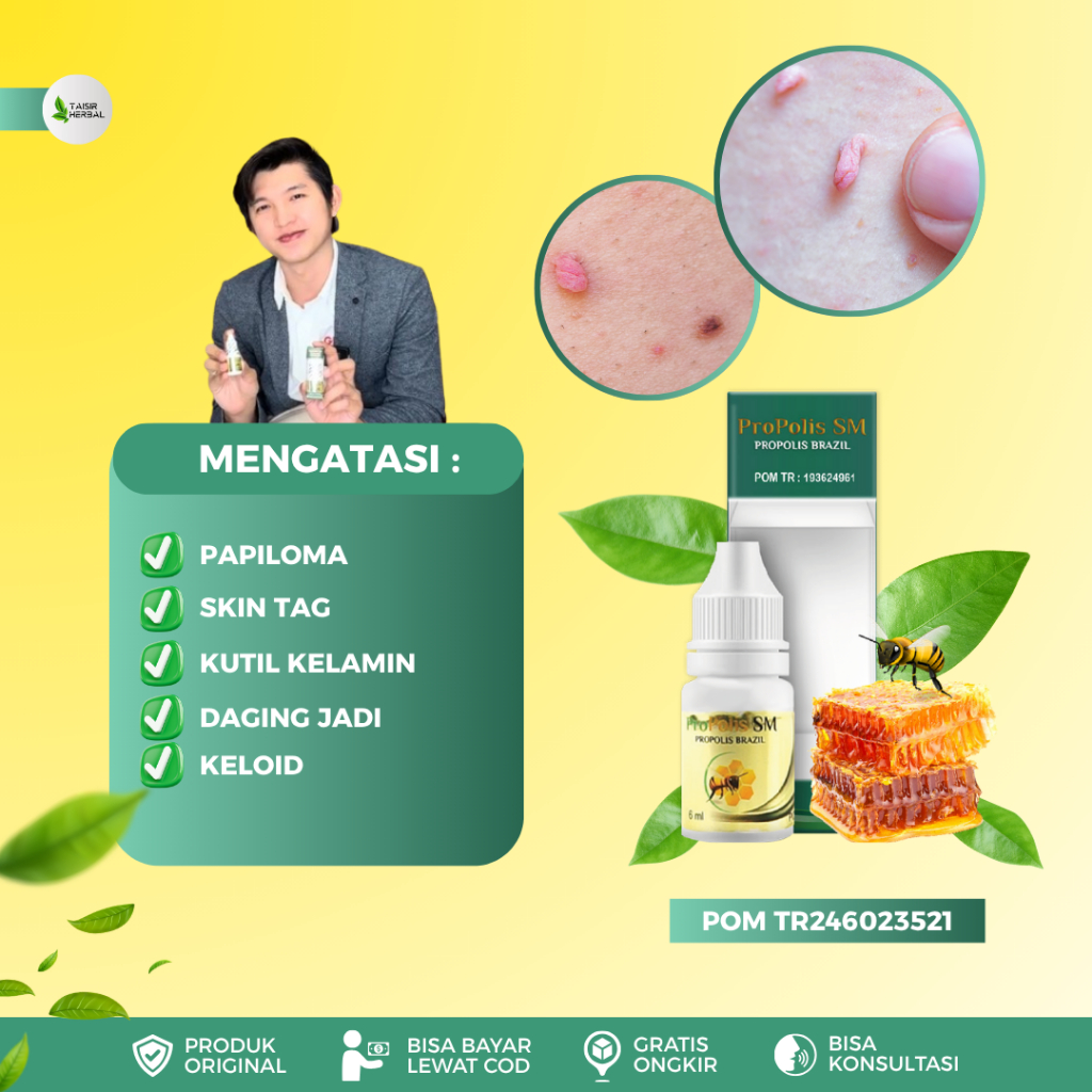 Obat Papiloma Di Leher, Obat Penghilang Papiloma, Obat Tetes Papiloma, Obat Papiloma Di Wajah, Obat 