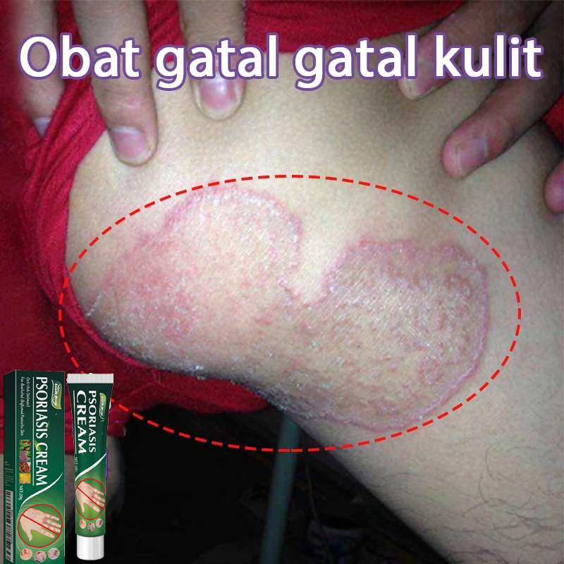 Salep Gatal Paling Ampuh Obat Gatal Kulit Eczema Cream Untuk Orang Yang Tua Dan Anak Untuk Seluruh T