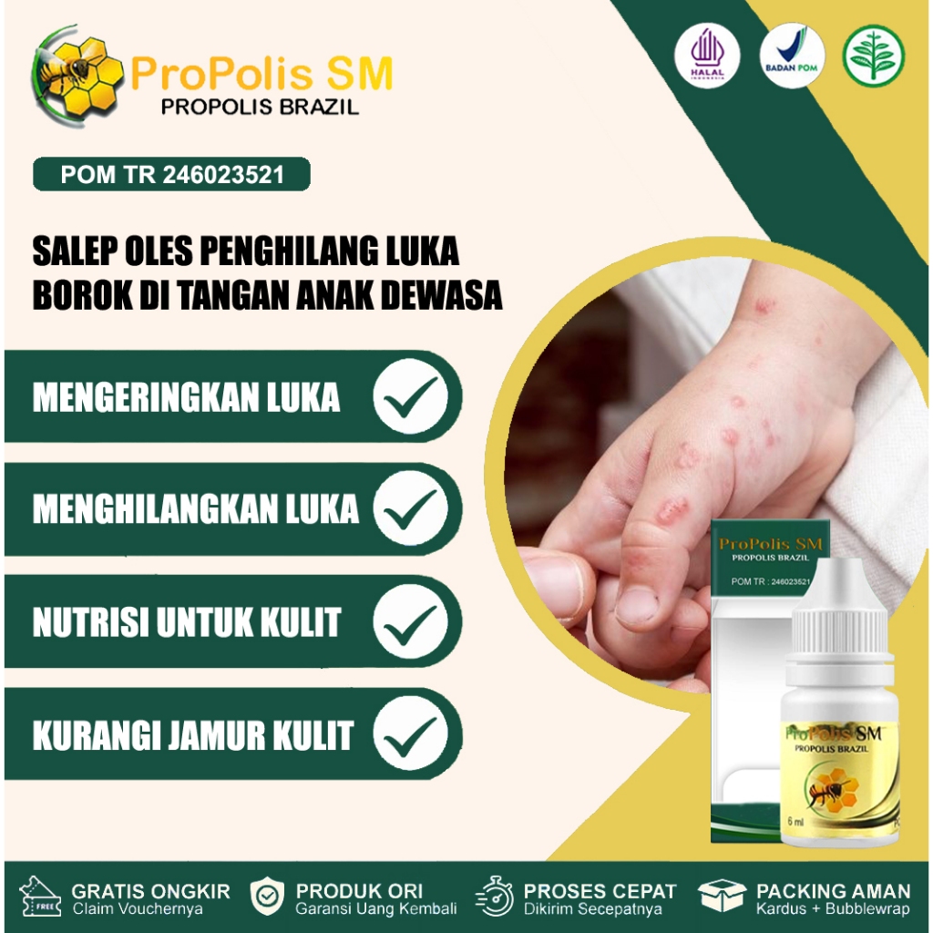 Obat Borok Di Tangan, Kulit Bernanah Pada Anak Dewasa, Menyembuhkan Luka Borok Dgn Propolis SM