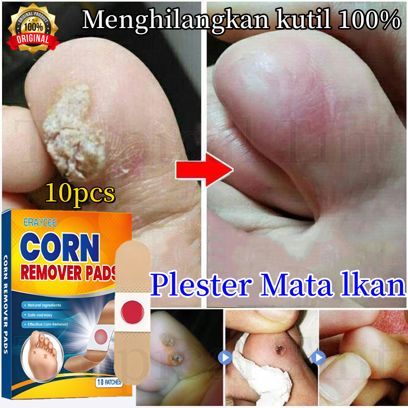 Plester Mata Ikan dan Kutil Plester Obat Kutil Foot Corn Removal Plester Obat Mata Ikan Plester Mata
