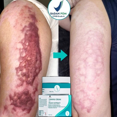 Penghilang bekas luka hitam koreng Salep penghilang bekas luka 20g cream penghilang bekas luka salep