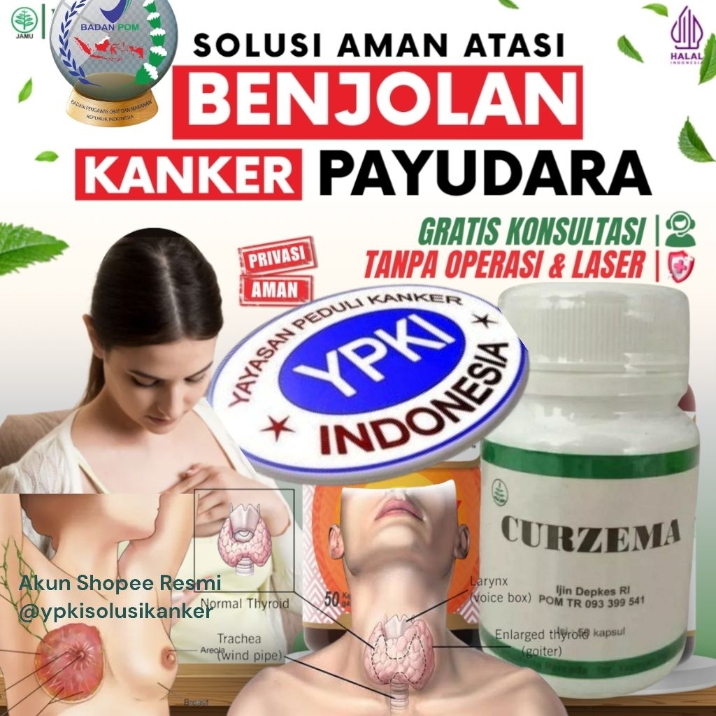 CURZEMA YPKI ll OBAT KANKER PAYUDARA BENJOLAN ll TERAPI OBAT KANKER PAYUDARA OBAT KANKER LIDAH STADI