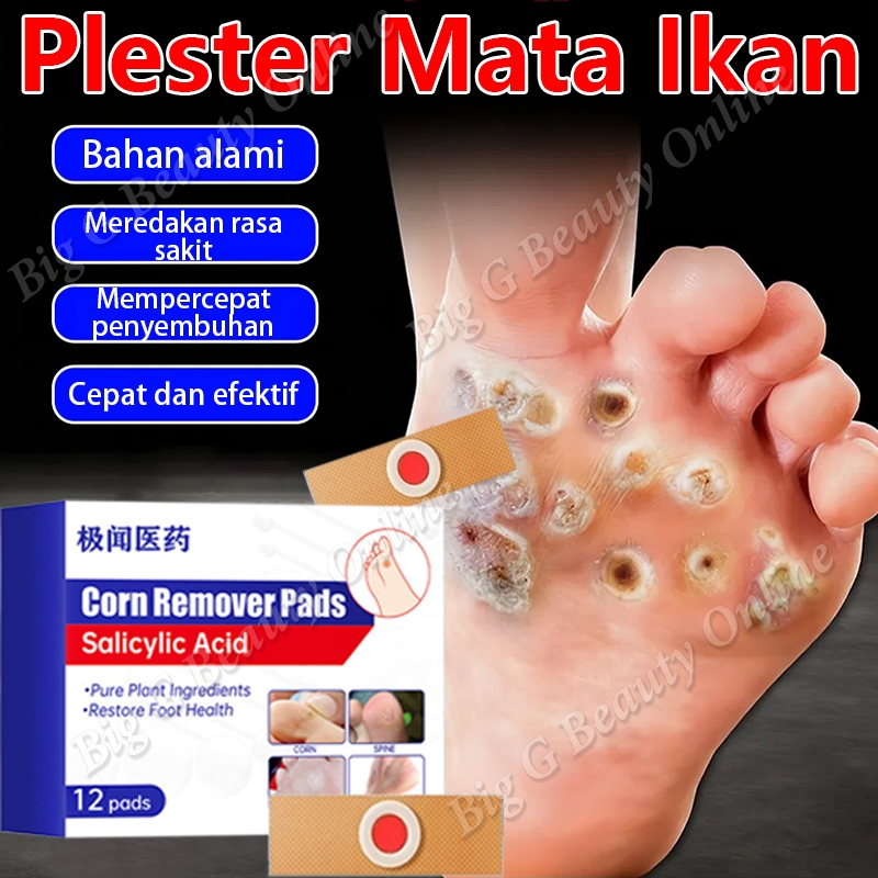Plester Mata Ikan Penghilang Kutil Dan Kapalan Obat Mata Ikan Foot Corn Remover Plester Mata Ikan Te