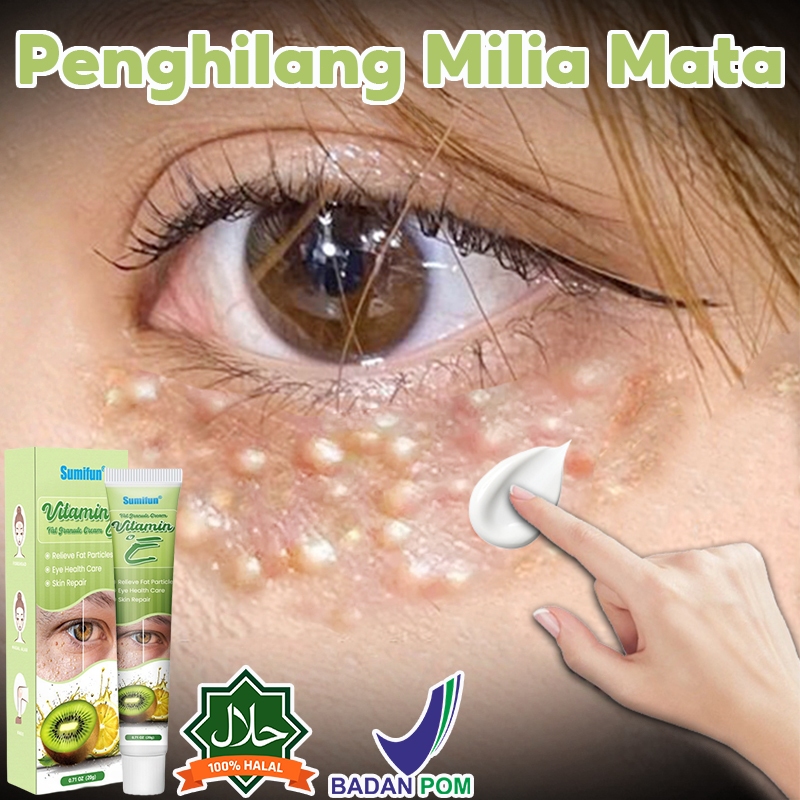 krim penghilang milia syringoma xanthelasma butiran lemak sekitar mata