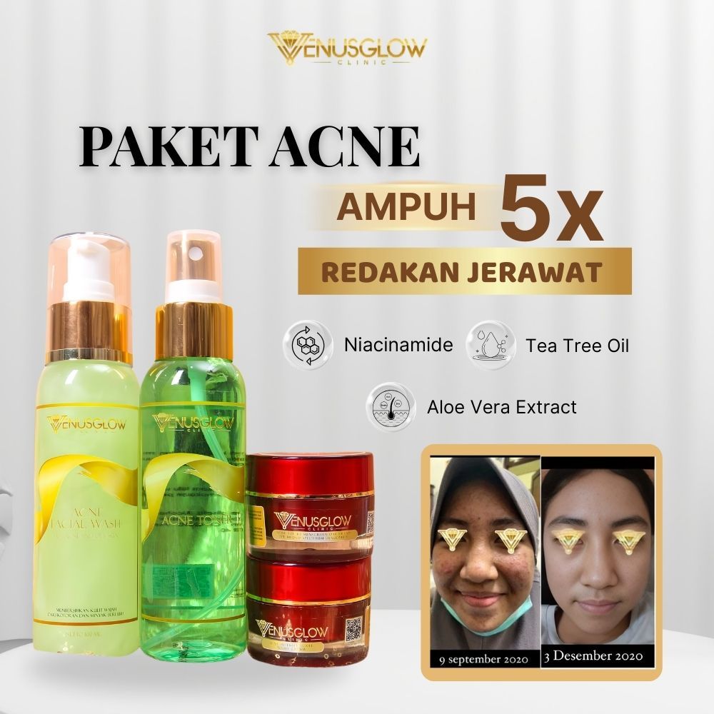 Paket Acne Venus glow Clinic Paket Skincare Anti Jerawat Acne Komplit Skincare Anti Jerawat dan Brun