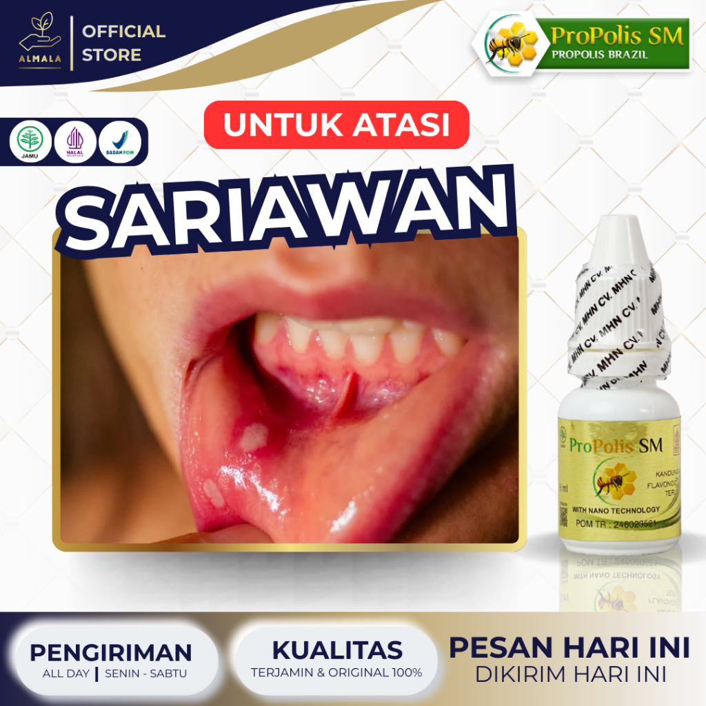 Obat Sariawan, Sariawan di Mulut, Sariawan di Lidah, Panas Dalam, Sariawan di Bibir - Propolis SM