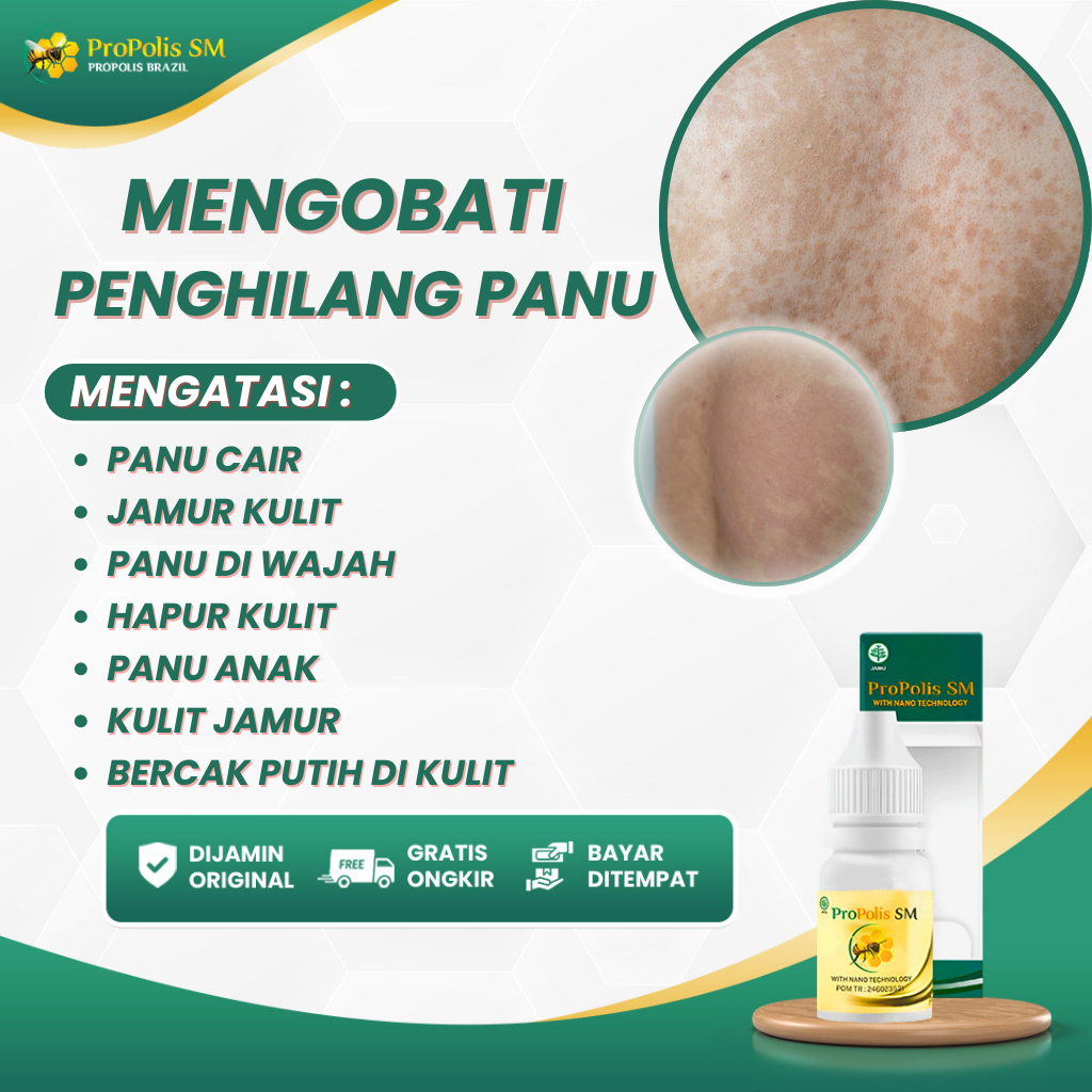 Obat Pengilang Panu, Obat Panu Cair, Obat Jamur Kulit, Obat Panu Di Wajah, Obat Hapur Kulit, Obat Pa