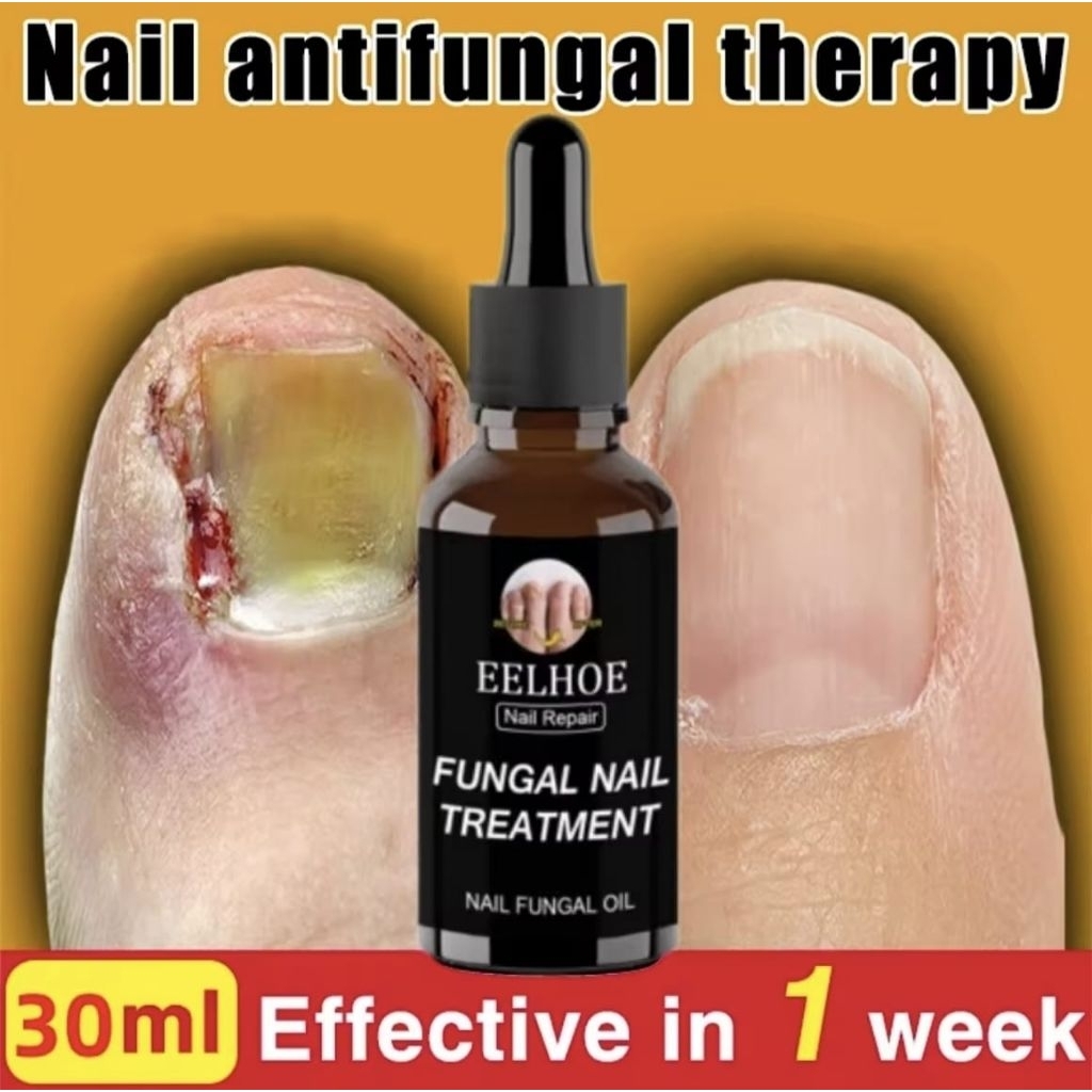 Esensi Perawatan Kaki dan Kuku / Gel Penghilang Jamur Kuku Jari Kaki Pemutih / Anti Infeksi Paroniki