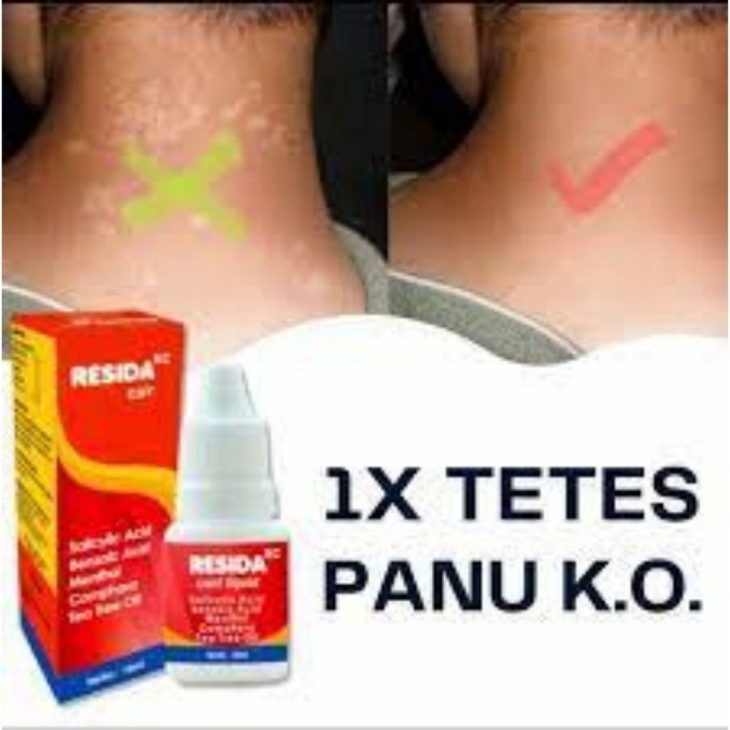 Resida Salep Panu Paling Ampuh 100% Obat Panu Cair Kurap Kadas Gatal Selangkangan Jamur Kulit Hapur 