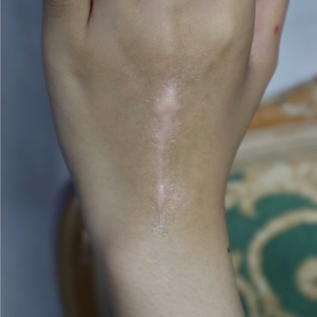 [PRODUK LOKAL] SILICONE PROSTHETIC KELOID | KELOID SCAR | PROSTETIK BEKAS LUKA PALSU | KELOID PALSU 