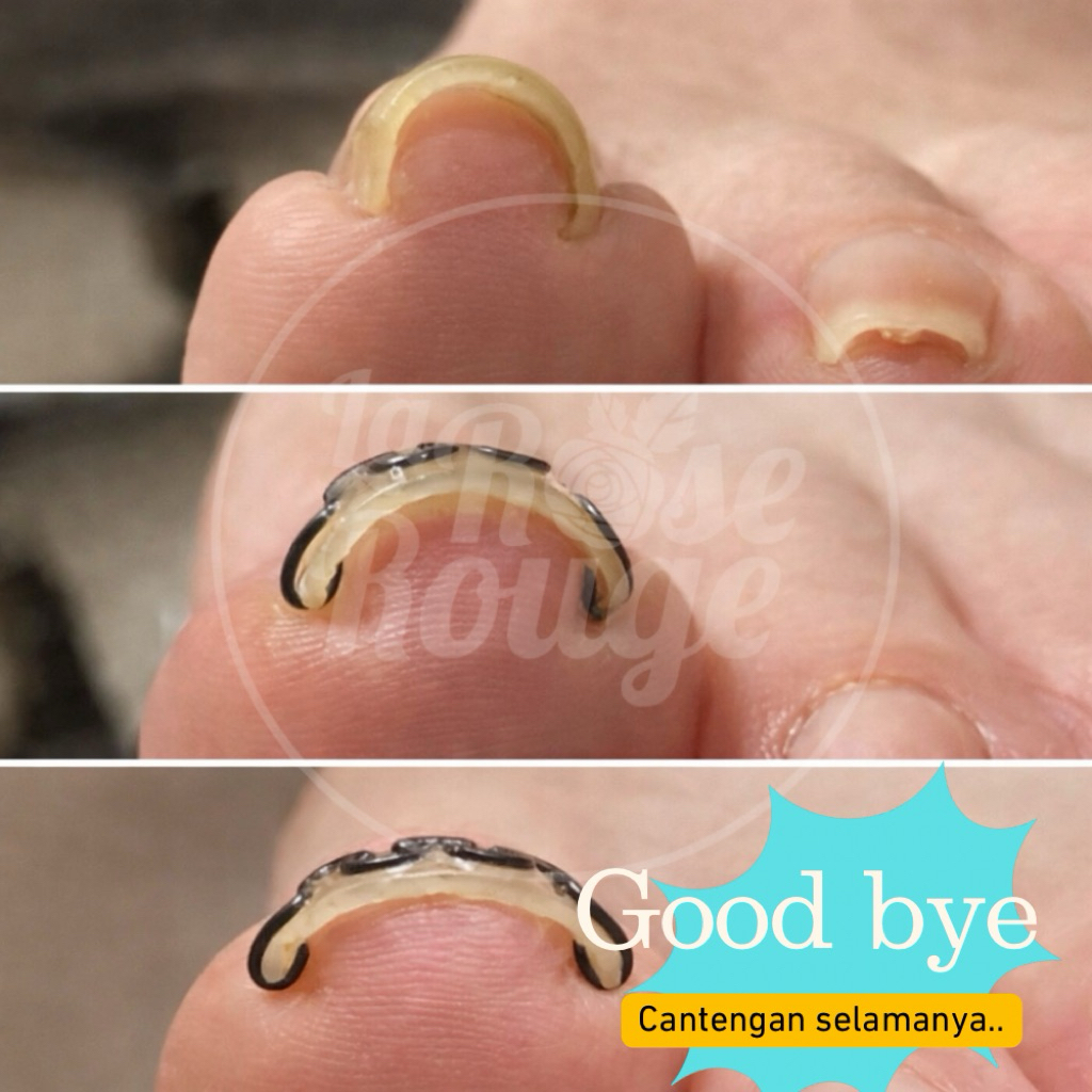 Alat Korektor Cantengan Kuku Kaki – anti cantengan & penghilang cantengan Kuku