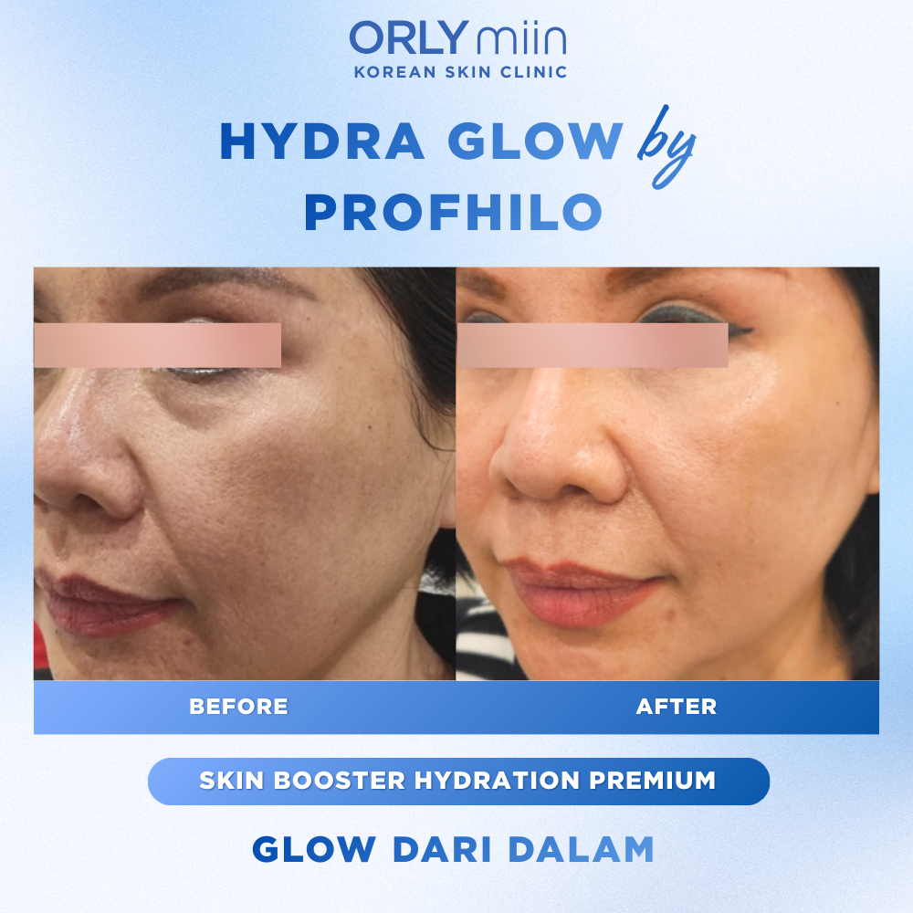 ORLYmiin Korean Skin Clinic | Hydra Glow by Profhilo – Skin Booster Premium untuk Kulit Lembap, Keny