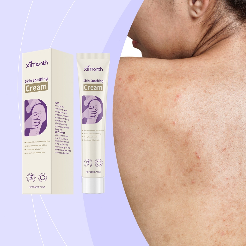 Ximonth Penghilang Jerawat Punggung 20g Bekas Jerawat Dan Flek Hitam Acnes Derma Care Herbal Essence