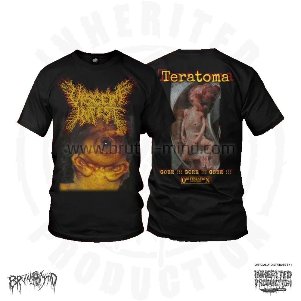 TS - VISCERA INFEST - Teratoma