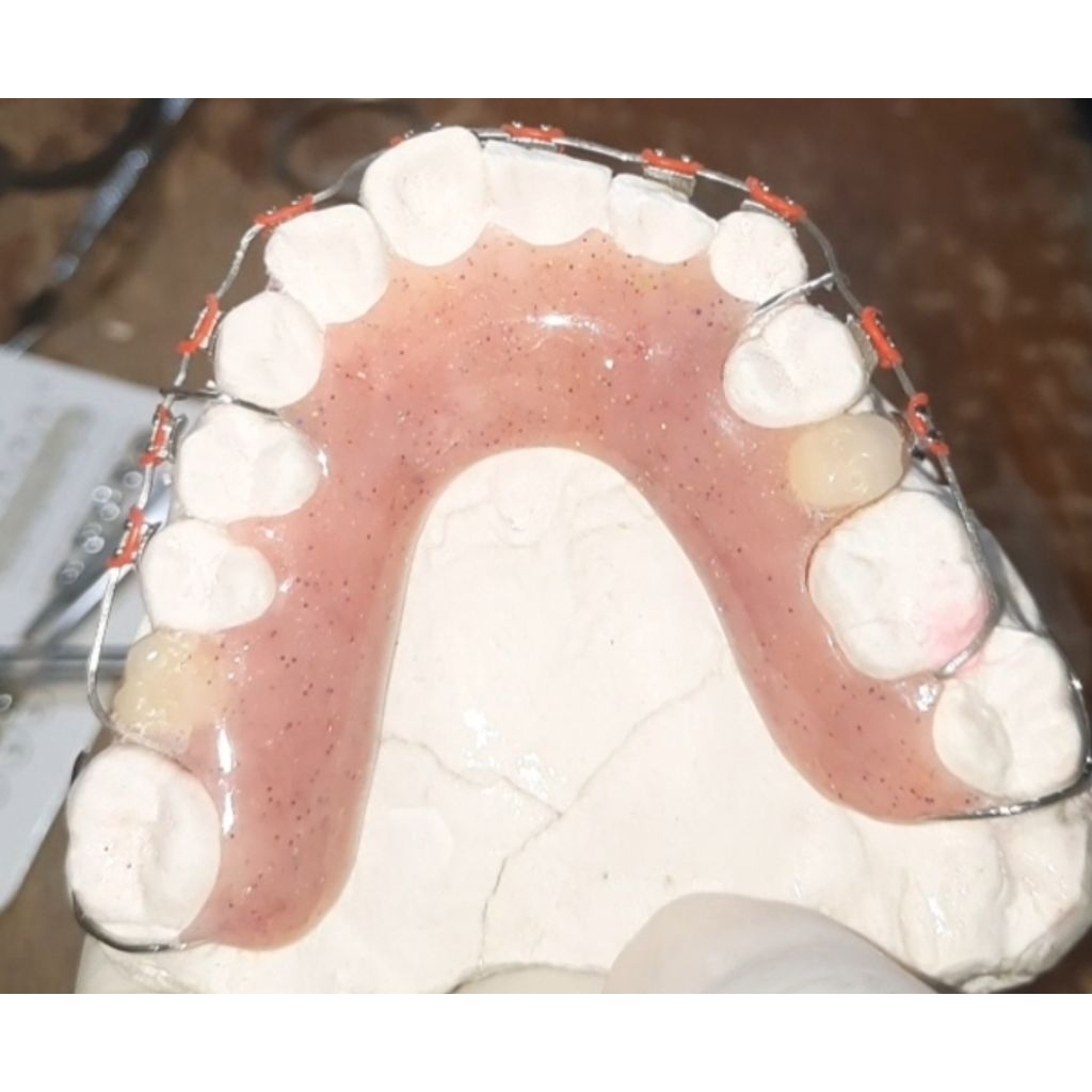 Behel lepas pasang dg kombinasi gigi palsu