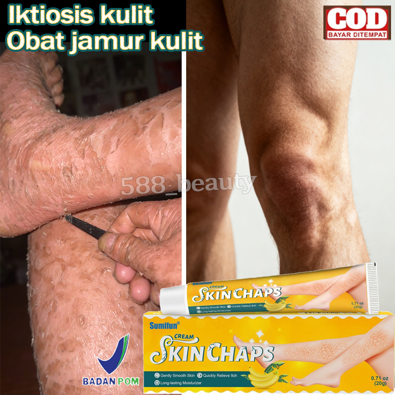 Obat gatal kulit Salep eksim Iktiosis Iktiosis kulit Obat jamur kulit Salep kulit 20g Krim kaki peca