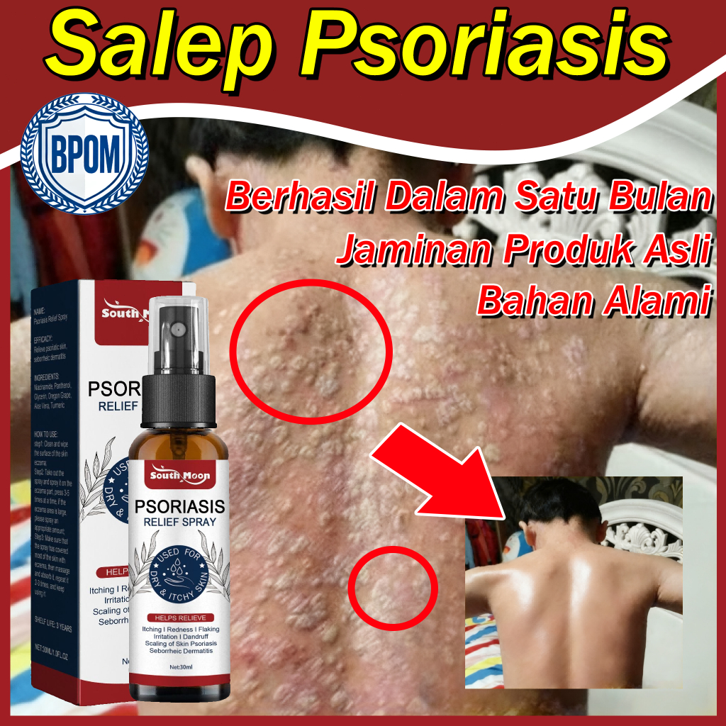 Salep Eksim Kering Dan Gatal Salep Gatal Yang Paling Ampuh Obat Gatal Untuk Selangkangan Salep Bayi 