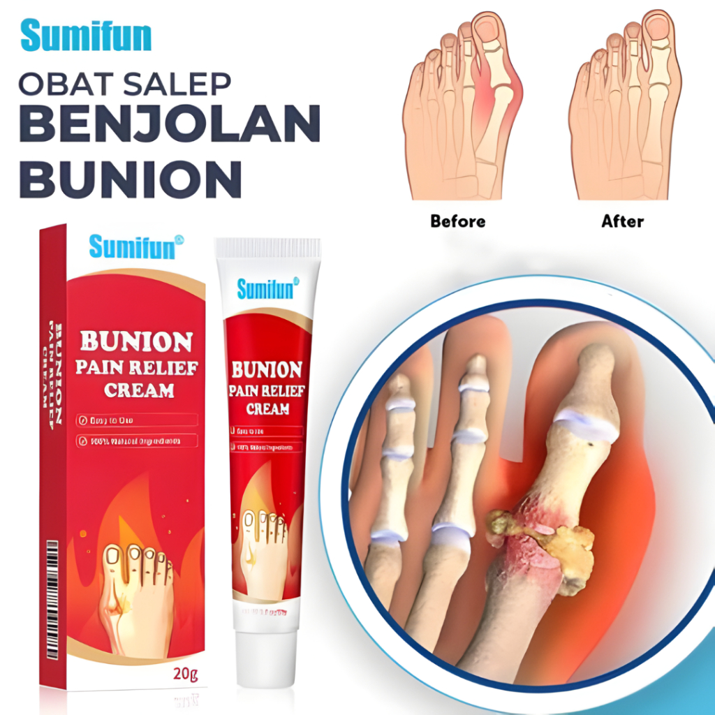 Sumifun Bunion Pain Relief Cream – Salep Pereda Nyeri Bunion & Pegal Sendi 20g