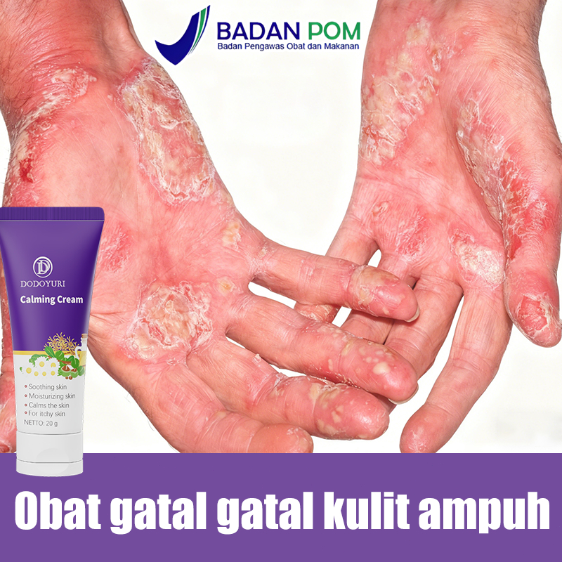Salep china gatal paling ampuh obat gatal selangkangan salep gatal selangkangan salep eksim kering d