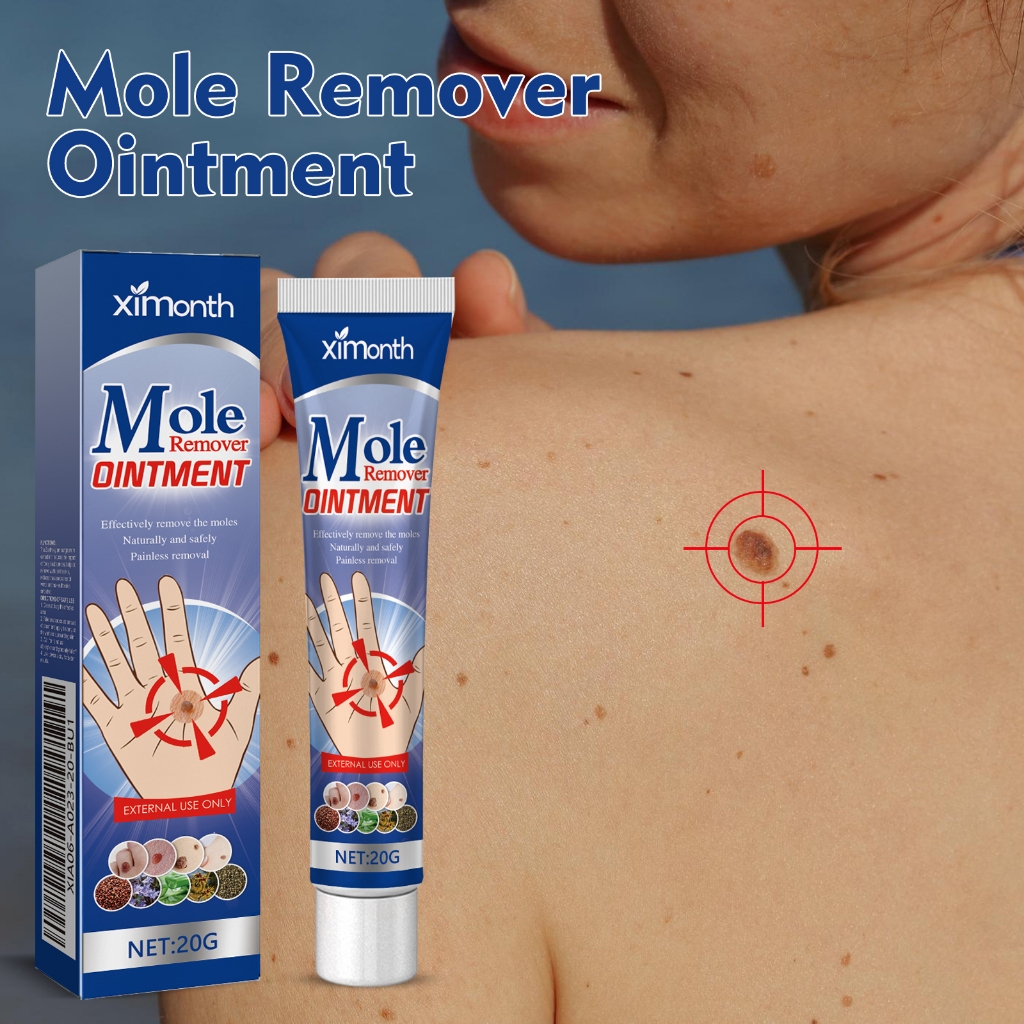 Ximonth Mole Remover Dintment 20g Krim Penghilang Kutil Tanpa Rasa Sakit, Penghilang Tahi Lalat Yang