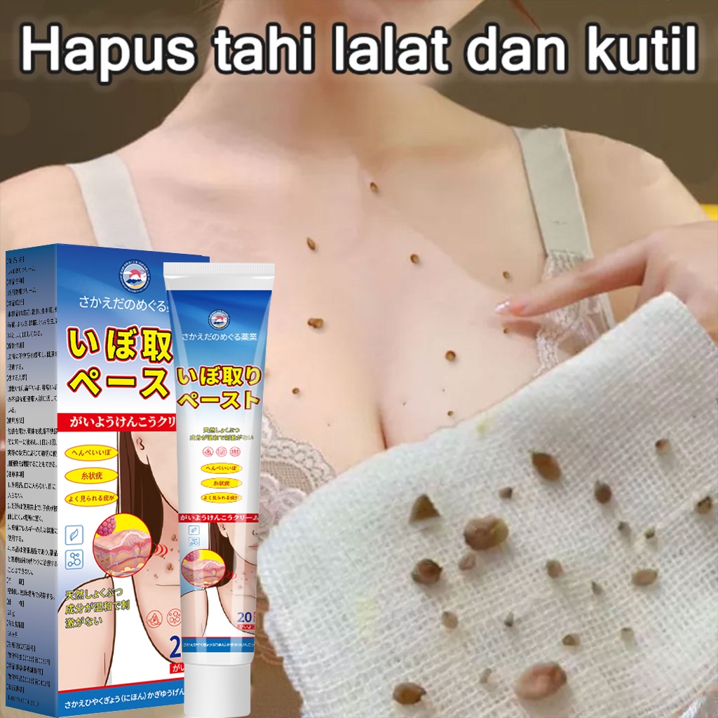 obat penghilang kutil skin tag remover obat kutil kelamin obat lalat 20g Obat Kutil ampuh dan tahi l