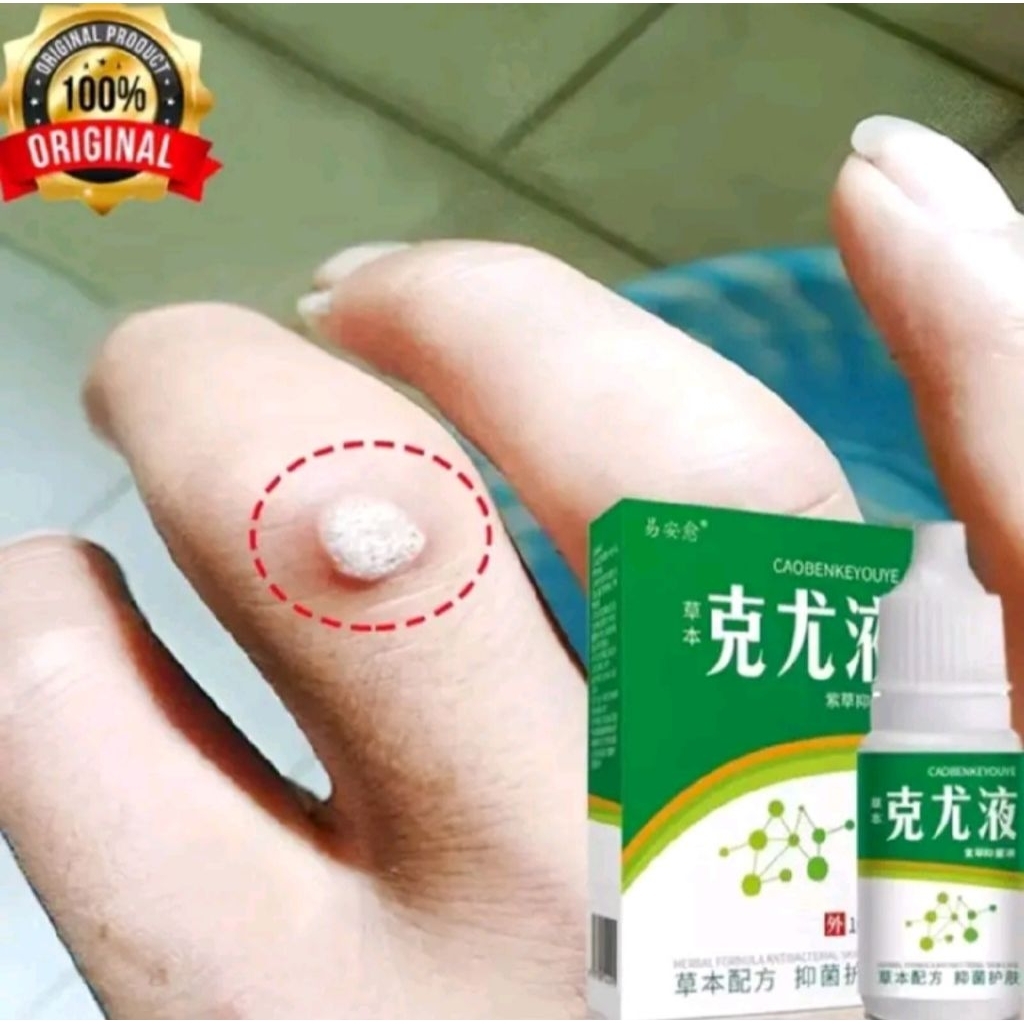 Obat Kutil Cara Cepat Hilangkan Semua Jenis Kutil TERBUKTI Ampuh 100 %Asli Original