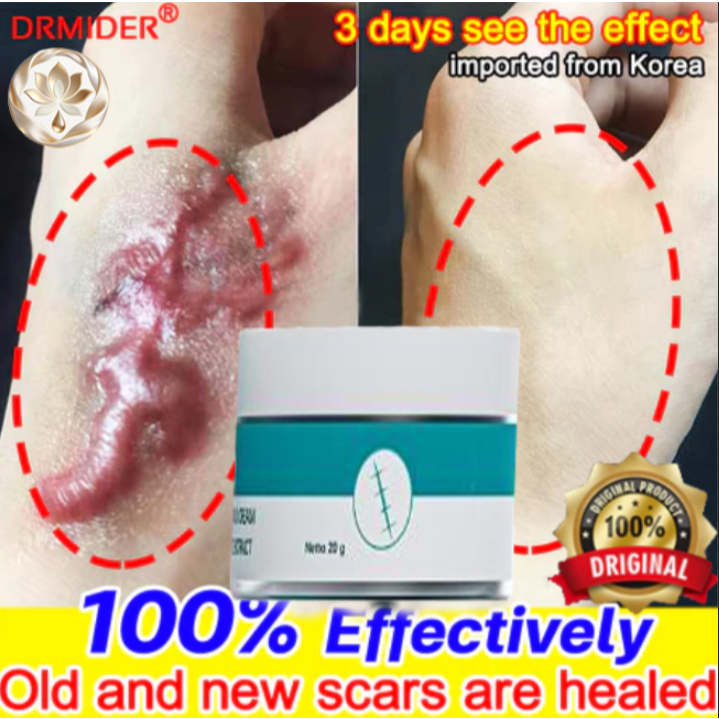 salep cina penghilang bekas luka hitam koren penghilang bekas luka cream penghilang bekas luka koren