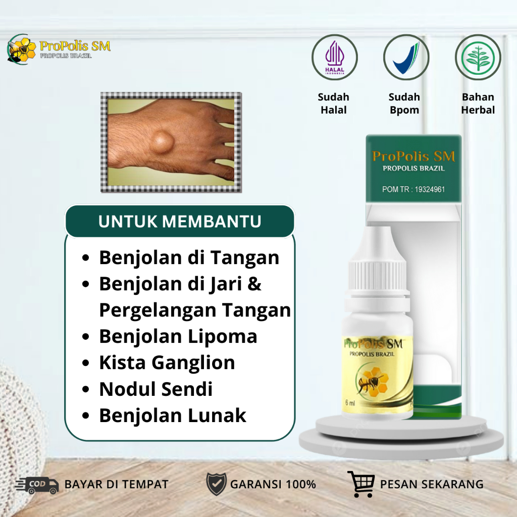 Obat Benjolan di Tangan, Obat Benjolan di Jari Tangan, Obat Benjolan di Pergelangan Tangan, Obat Tan