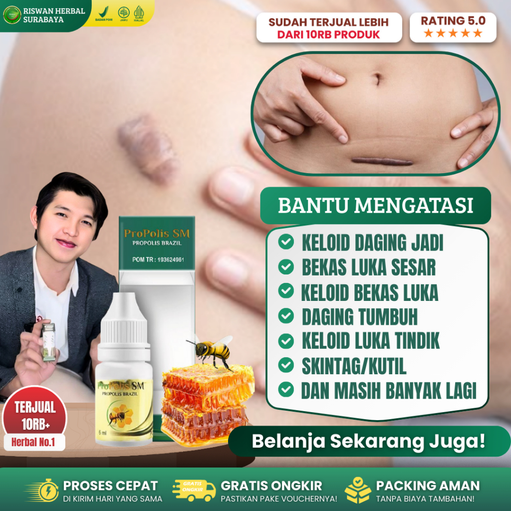 Obat Keloid Bekas Operasi Penghilang Keloid Penghilang Bekas Luka Menahun Obat Keloid Propolis SM Or