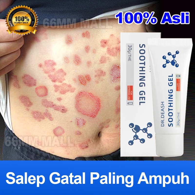 Salep Eksim Kering dan Gatal Salap Gatal Kulit Yang Ampuh Obat Gatal Selangkangan Obat Eksim Salep B