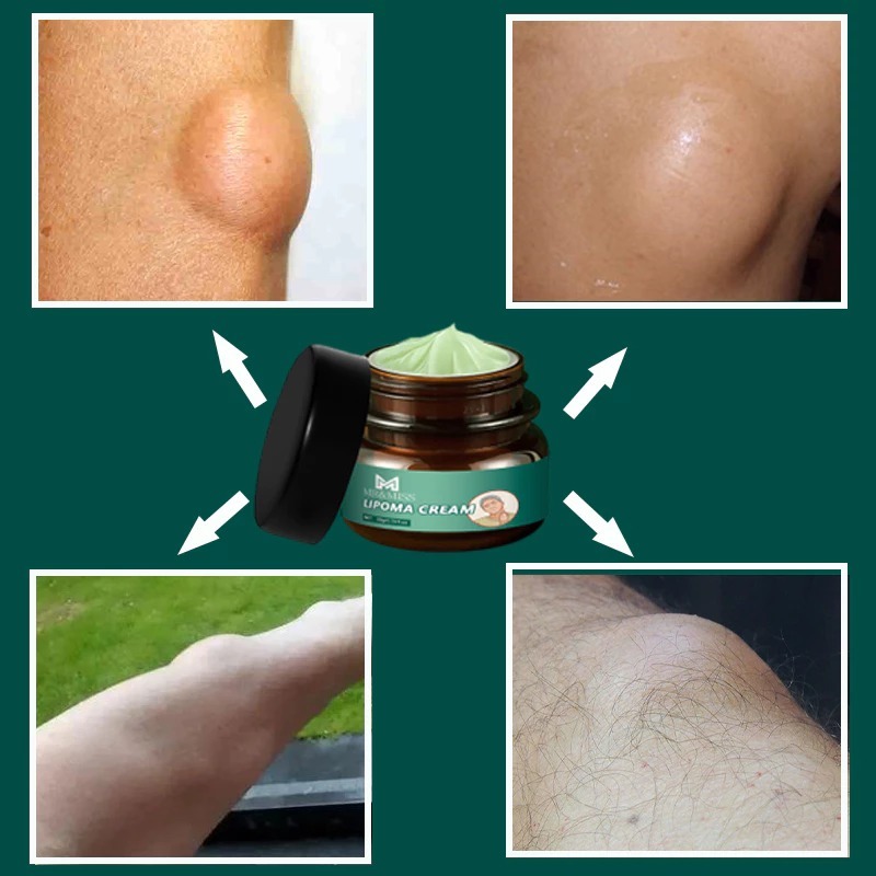 Lipoma cream original Obat benjolan Lipoma removal cream original Obat lipoma Salep lipoma salep ben