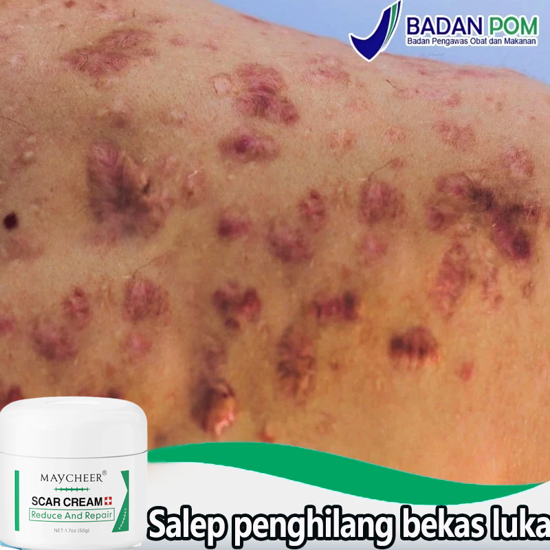 Maycheer Salep penghilang bekas luka Penghilang bekas luka hitam koreng Obat penghilang bekas luka M