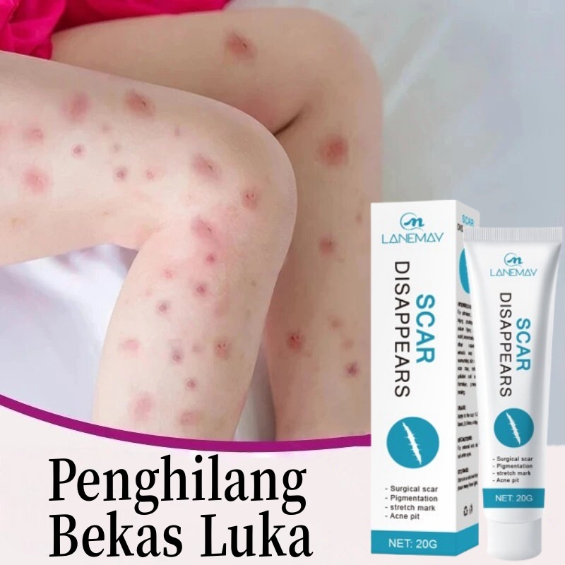 Bekas luka hitam di kaki Cream penghilang bekas luka koreng Salep bekas luka anak Pembersih bekas lu
