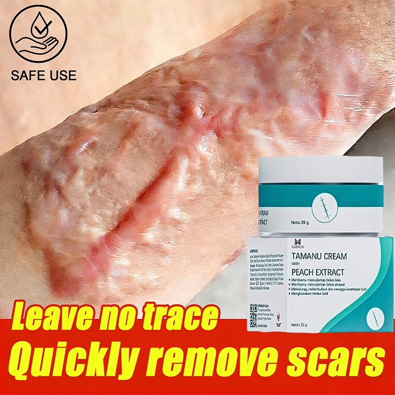 Krim Penghilang Bekas Luka Obat Penghilang Bekas Luka Bekas Luka Jahitan Gigitan Serangga Bekas Luka