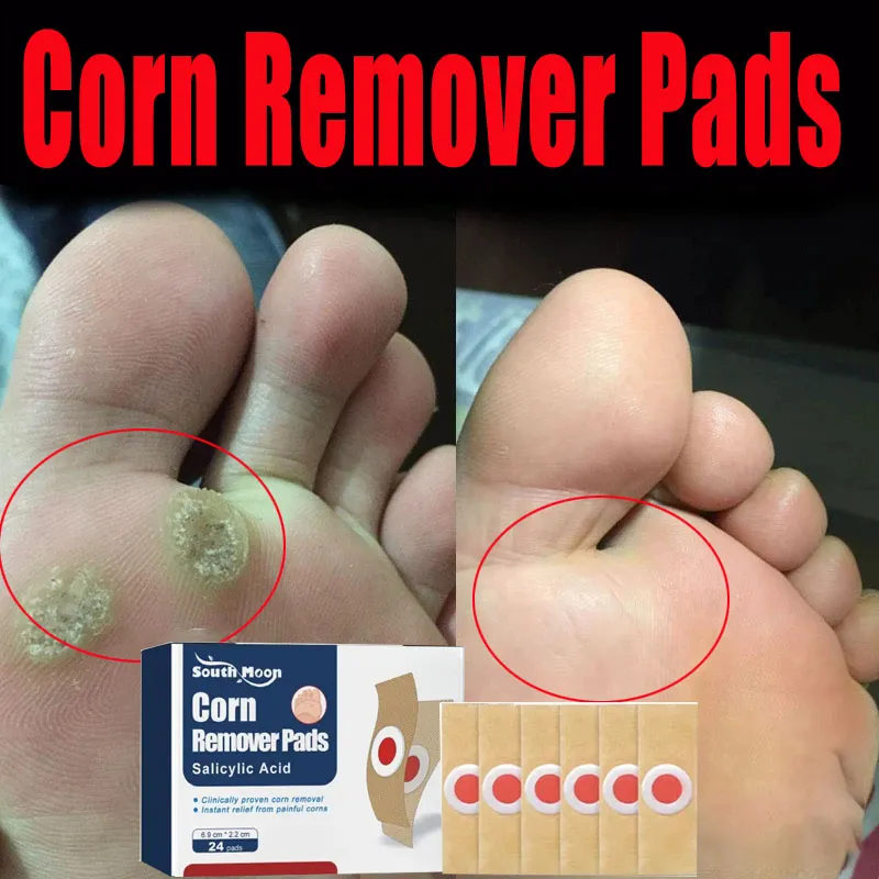 Plester Mata Ikan Paling Ampuh 0bat Mata Ikan Di Kaki Penghilang Mata Ikan Di Tangan Foot Corn Remov