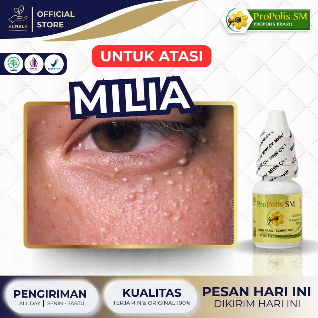 Obat Milia, Penghilang Milia, Milia di Bawah Mata, Bintik di Mata, Bruntusan - Propolis SM ASLI 100%