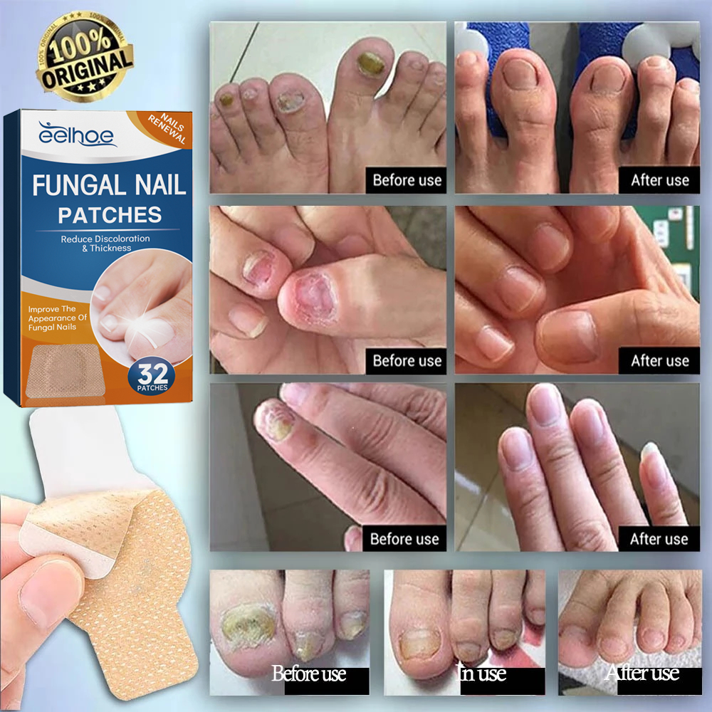 Obat Jamur Kuku Obat Cantengan Obat Kuku Rusak Pembersih Kuku Kaki Hitam Fungal Nail Treatment Funga