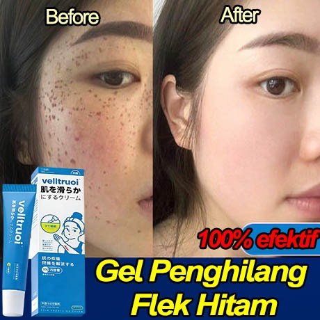 Krim Penghilang Flek Hitam Membandel Gel Penenang Kulit Menghilangkan Flek Hitam Di Wajah Pudar Flek