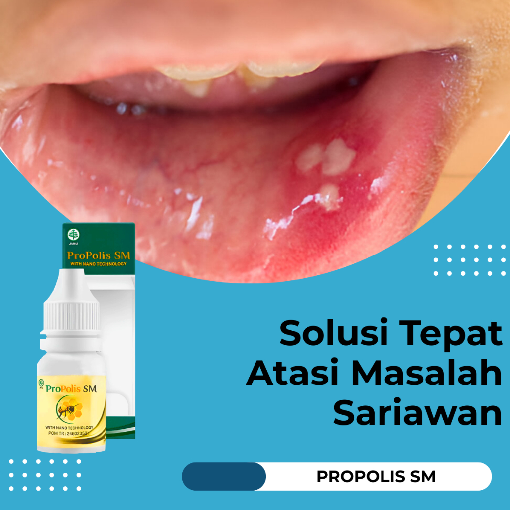Obat Sariawan Menyembuhkan Sariawan Obat Sariawan Parah - Propolis SM Premium Brazil