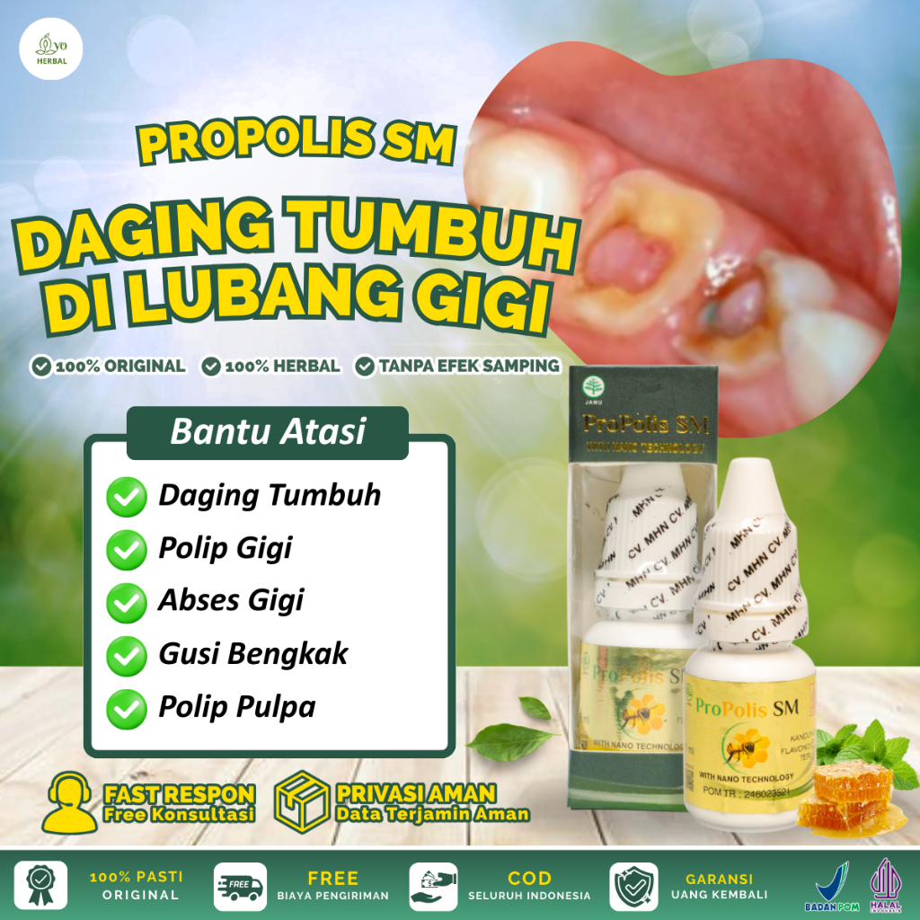 Propolis SM Brazilian Untuk Polip Gigi, Polip Pulpa, Daging Tumbuh di Lubang Gigi, Gusi Bengkak, Pol