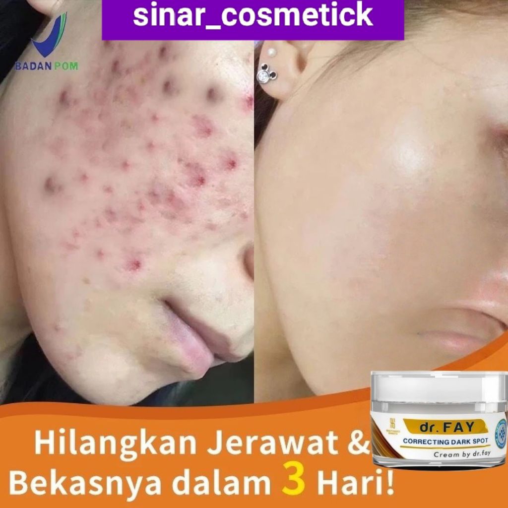 DR FAY CREAM PENGHILANG BOPENG JERAWAT &  BEKAS JERAWAT ( DR FAY )