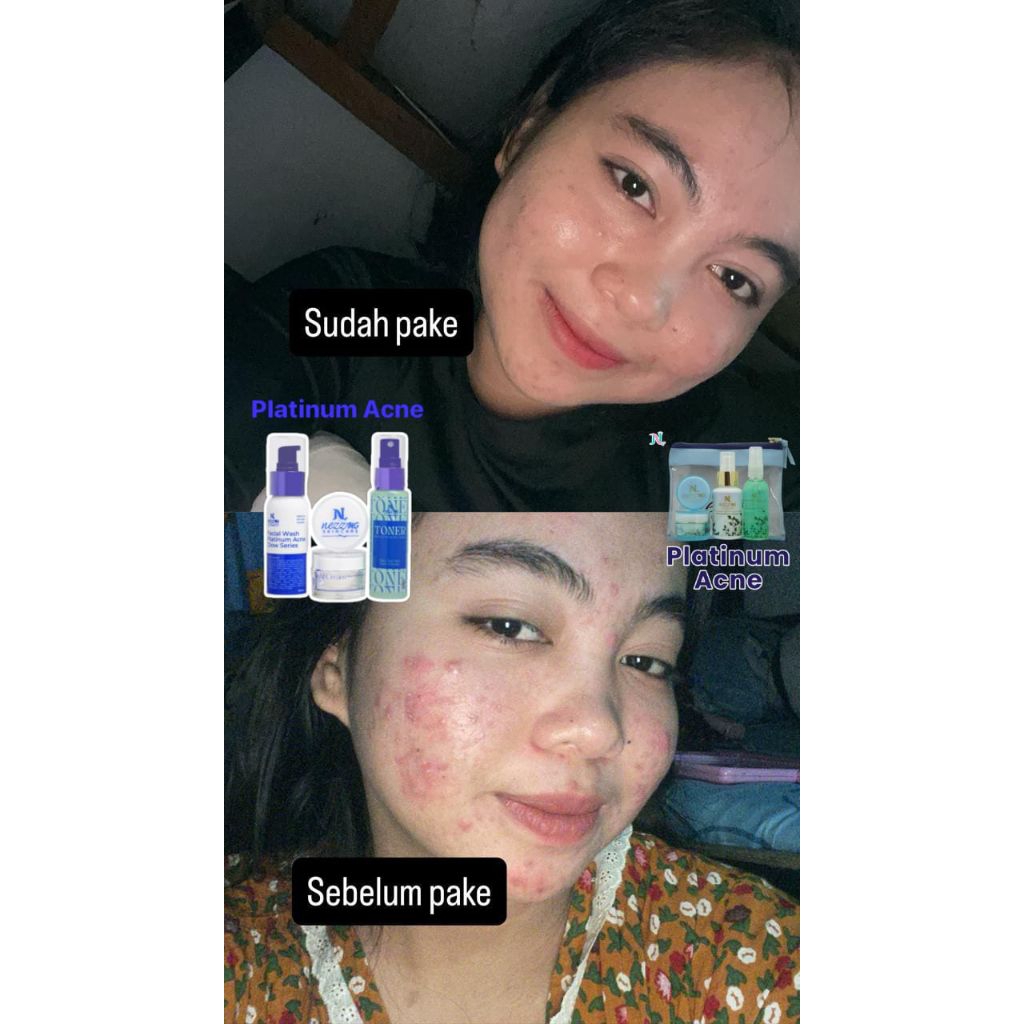 Nezzmg platinum acne