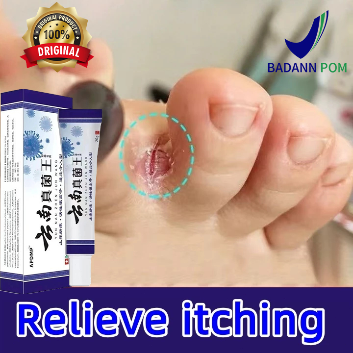Krim Perawatan Kaki Gatal & Kering - Hilang Bau & Mengelupas Perawatan Kaki Alami - Atasi Gatal & Ku
