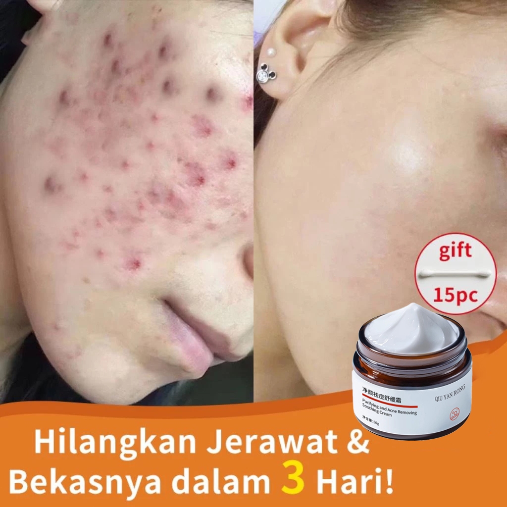 Acne-removing face cream, effective ointment for removing acne marks, improves acne marks and pits, 