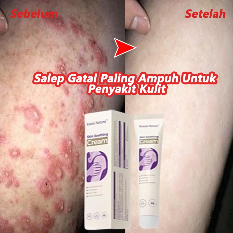 Salep Gatal Paling Ampuh Untuk Penyakit Kulit Salep Gatal Selangkangan Gatal Dan Hitam 0bat Kurap Am