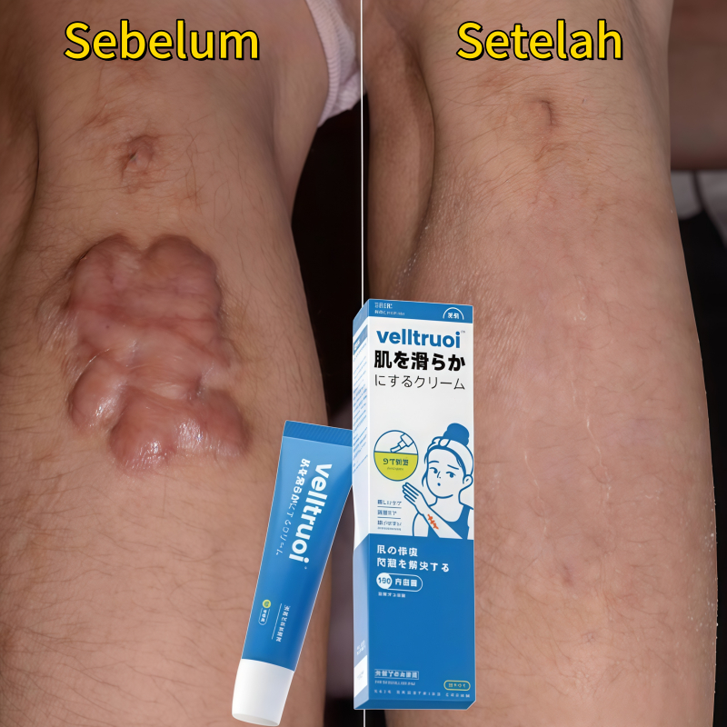 Salep penghilang bekas luka Menghilangkan bekas luka menghitam Salep keloid Cream penghilang bekas l