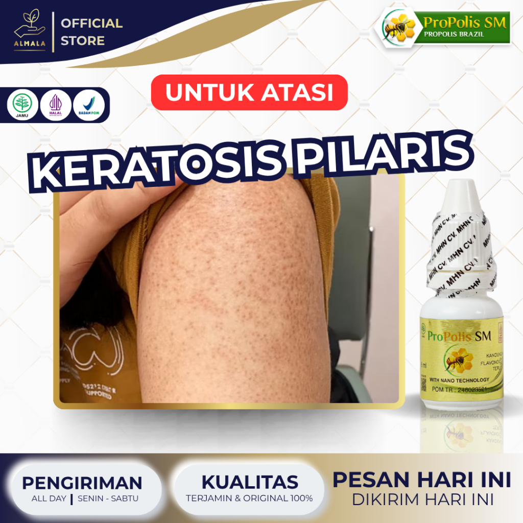 Obat Keratosis Pilaris, Penyakit Kulit Ayam, Penghilang Bintik Pada Kulit, Kulit Gatal Bruntusan, Be